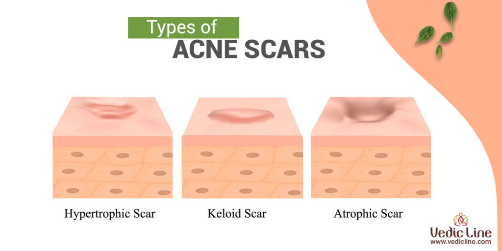 Types of acne scars-Vedicline